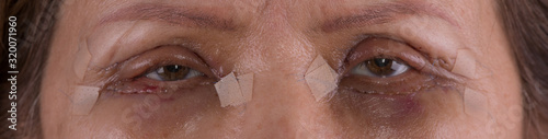 Eyes of an old woman after plastic surgery,blepharoplasty,eye bag removal