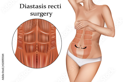 Diastasis  Recti  Surgery (stretching of the linea alba). Abdominoplasty photo