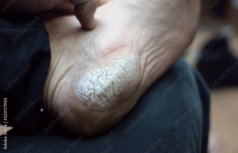 Dermatitis, sweating of the skin of the feet of a man due to bad shoes