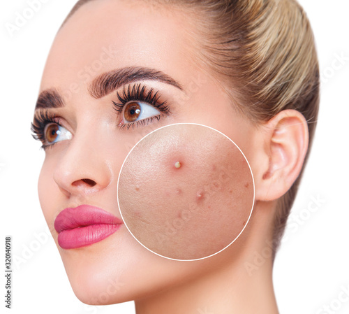 Face of beautiful woman with zoom circle before and after acne treatment.