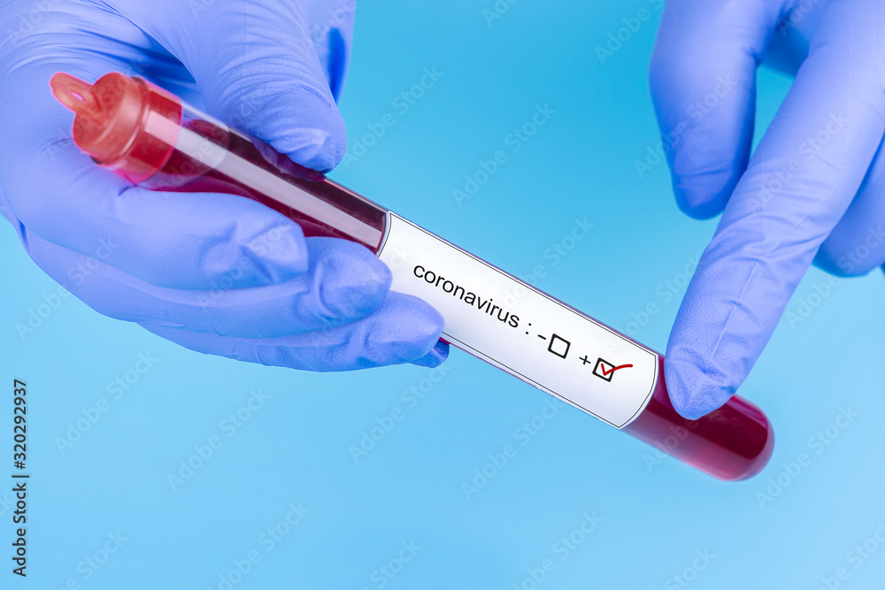 Fototapeta premium Coronavirus. Doctor's hand in a medical glove. Blood sample in vitro for analysis.The medecine. Analyzes. Viruses.