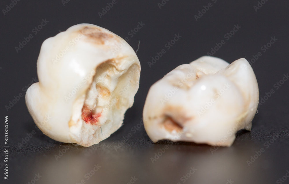 tooth decayed caries on a black background