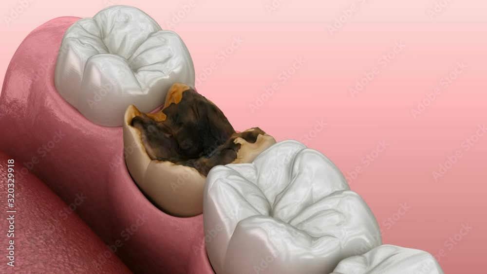 Periostitis tooth Lump on Gum Above Tooth. Medically accurate dental