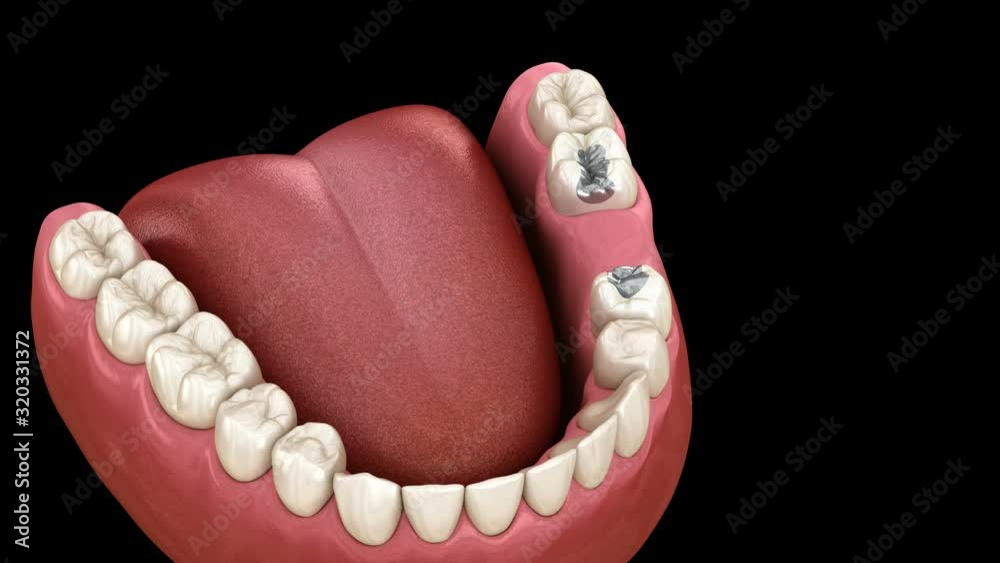 Amalgam removing and preparation for ceramic bridge placement. Medically accurate 3D animation
