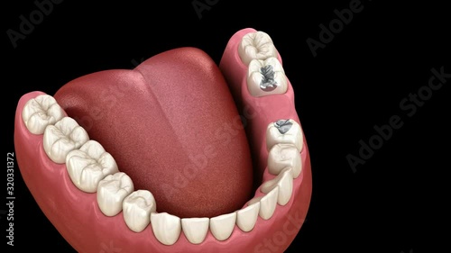 Amalgam removing and preparation for ceramic bridge placement. Medically accurate 3D animation photo