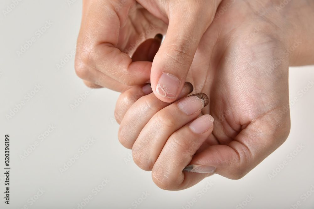 © ARTFULLY-79 - Nails fungal and bacteria infection from dirty manicure salon tools, Hand gel polish flaking and chipping, Fingernails brittle problems. © ARTFULLY-79 - Nails fungal and bacteria infection from dirty manicure salon tools, Hand gel polish flaking and chipping, Fingernails brittle problems.