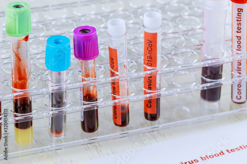 Coronavirus blood test 2019-nCoV,SARS-CoV, MERS-CoV blood test in Laboratory