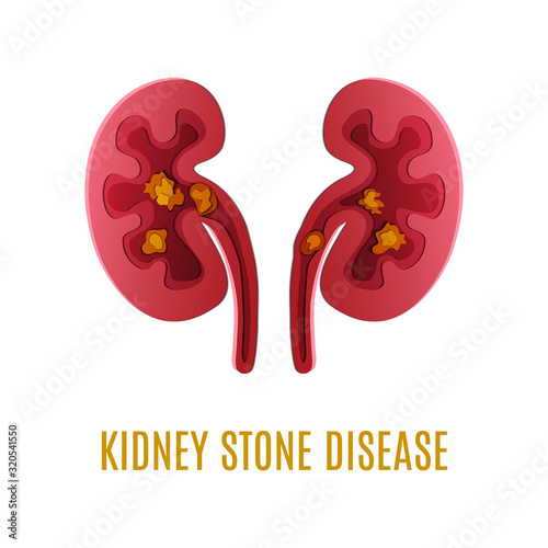 Kidney stone disease awareness poster with kidneys made in paper cut craft style on white background. Renal stones illustration. Medical solidarity concept. Human body organ anatomy icon. 