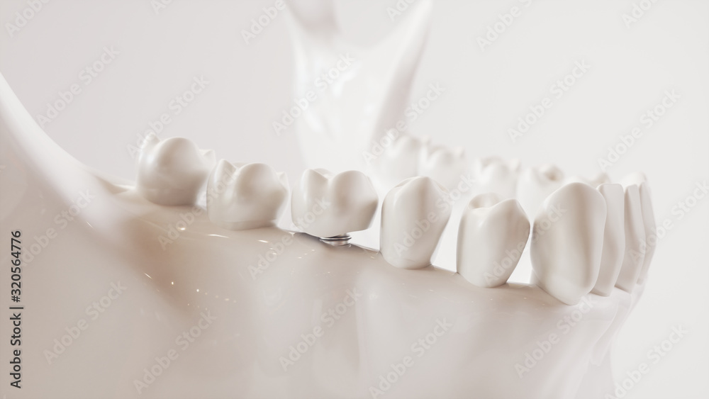 Tooth implantation picture series V02 - 8 of 8 - 3D Rendering Tooth implantation picture series V02 - 8 of 8 - 3D Rendering