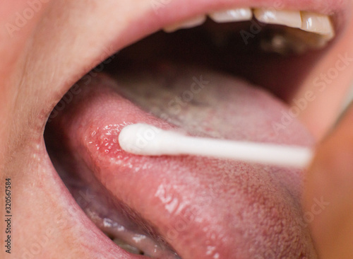 Taking a smear for a disease in the tongue of a woman. Glossitis and gingivitis tongue disease research concept, medical