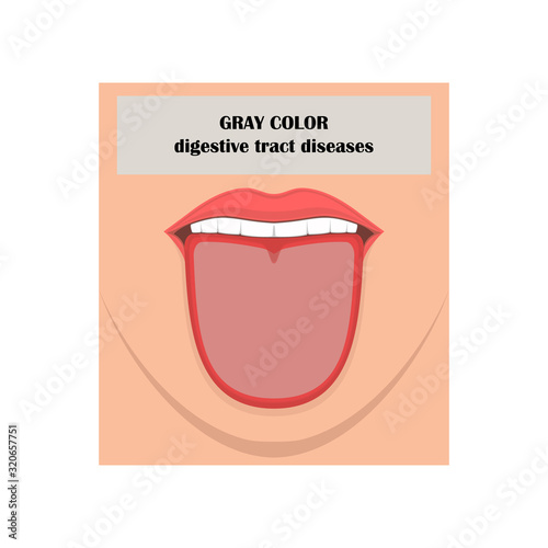 Lower face, open mouth, tongue. The inscription GRAY COLOR, digestive tract diseases. Vector illustration.