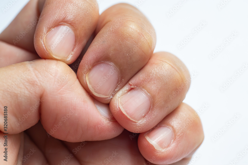 Woman peeled middle finger and wound skin on left hand, White background, Close up & Macro shot, Selective focus, Asian Body skin part, Healthcare concept