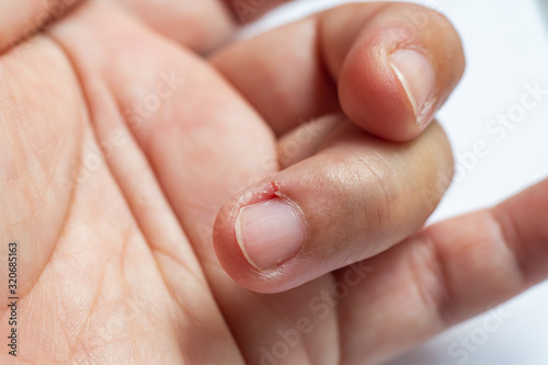 Woman peeled middle finger and wound skin on left hand  White background  Close up   Macro shot  Selective focus  Asian Body skin part  Healthcare concept