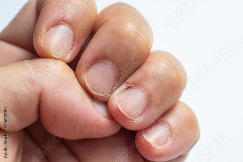 Woman peeled middle finger and wound skin on left hand  White background  Close up   Macro shot  Selective focus  Asian Body skin part  Healthcare concept