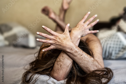 crossed arms of a Woman with heavy Cuts and scars of self-mutilation, self-abusing, Borderline personality disorder. photo