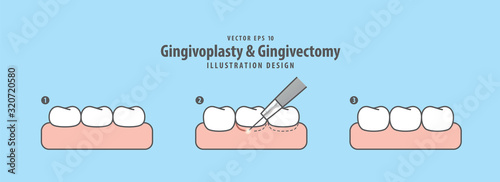 Gingivoplasty & Gingivectomy step electrosurgery cut gum off illustration vector on blue background. Dental concept.