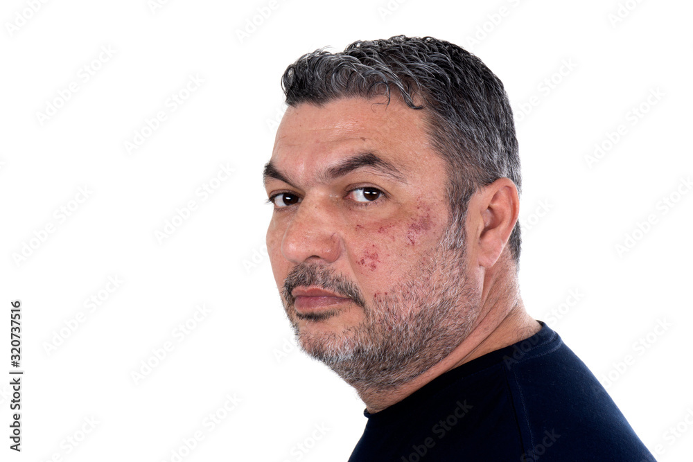 portrait of mature man with injured face portrait of mature man with injured face