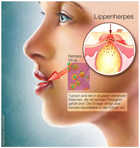 Lippenherpes photo