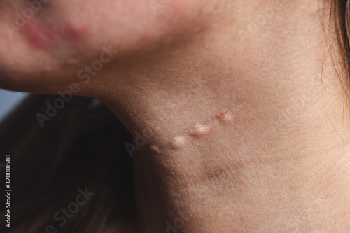 Real skin Biorevitalization. Traces of biorevitalization injections on the neck. Biorevitalization needle marks on the neck