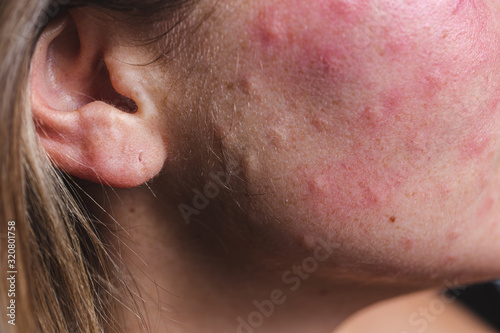 Real skin Biorevitalization. Traces of biorevitalization injections on the neck. Biorevitalization needle marks on the face