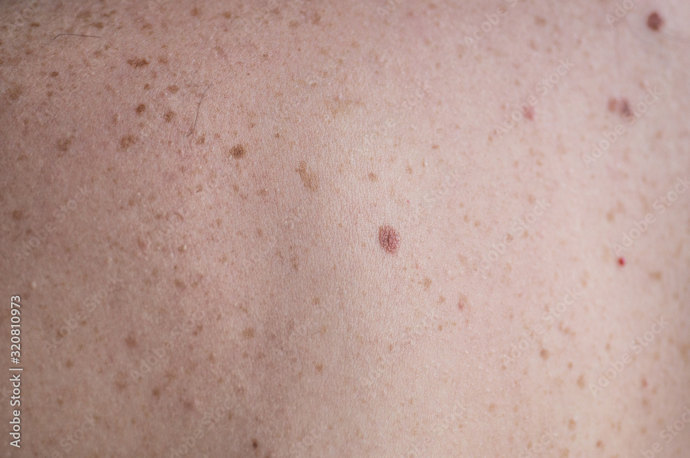 Checking benign moles. Close up detail of the bare skin on a man back with scattered moles and freckles.