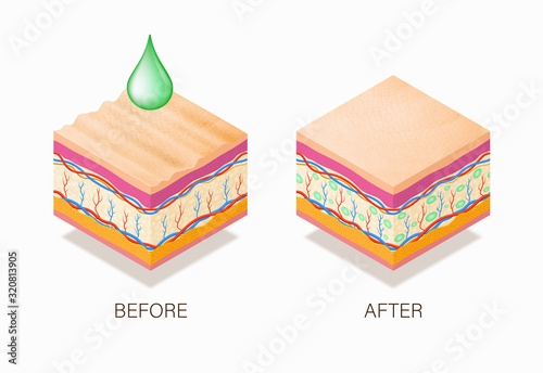 Anti-aging concept with before and after beauty treatment. Good example of how it works cosmetic filler or Dermal fillers as a cream or injection. Vector illustration skin structure.