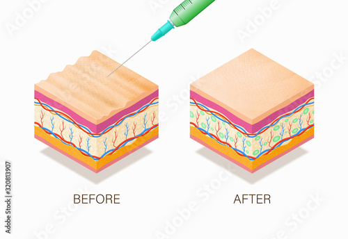 Anti-aging concept with before and after beauty treatment. Good example of how it works cosmetic filler or Dermal fillers as a cream or injection. Vector illustration skin structure.