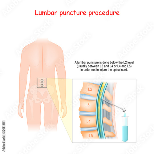 Spinal Tap Procedure. Detailed diagram of lumbar puncture.