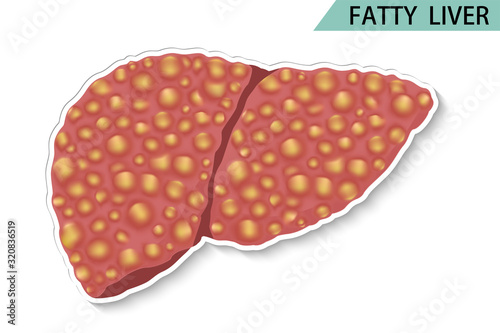 vector of fatty liver health care concept