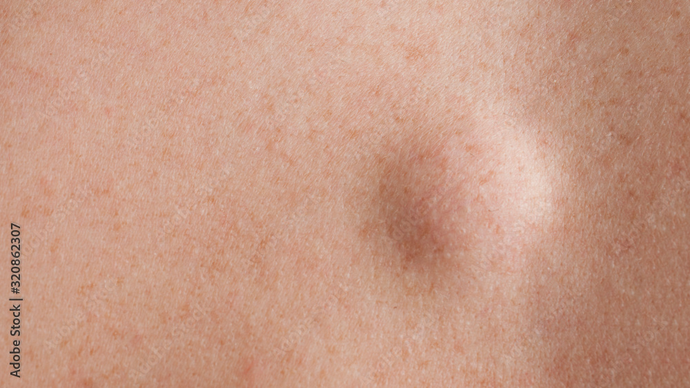 Round lipoma close up shot on the back of a caucasian man