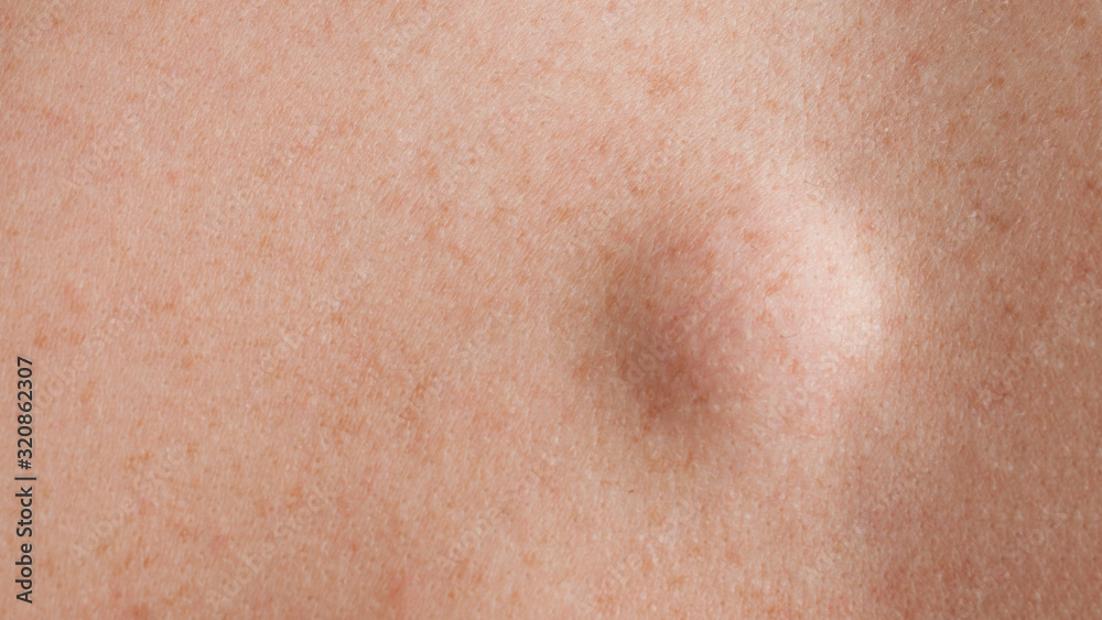 Round lipoma close up shot on the back of a caucasian man Round lipoma close up shot on the back of a caucasian man