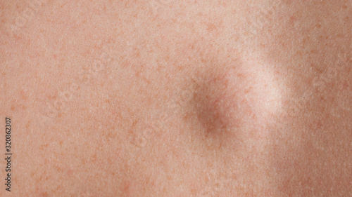 Round lipoma close up shot on the back of a caucasian man photo