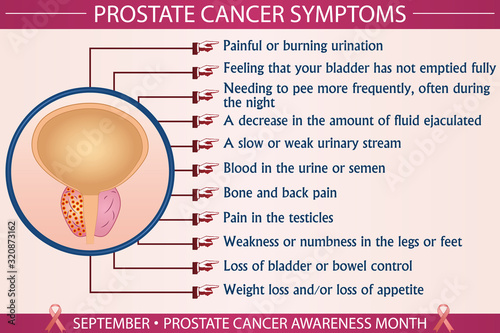 Prostate cancer symptoms infographic vector illustration. Health, healthcare, and september prostate cancer awareness month concept for presentation, brochure, banner. Eps 10 format, printable colors.