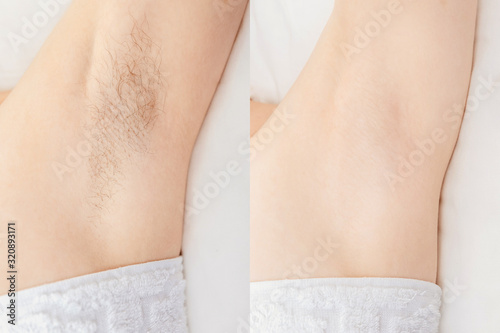 Women underarm hair removal. Concept before and after shaving sugar depilation laser