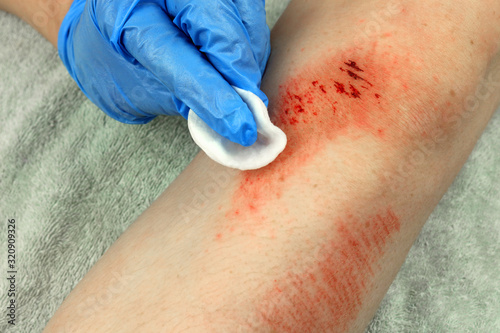 A surgical wipe being used to clean a skin abrasion