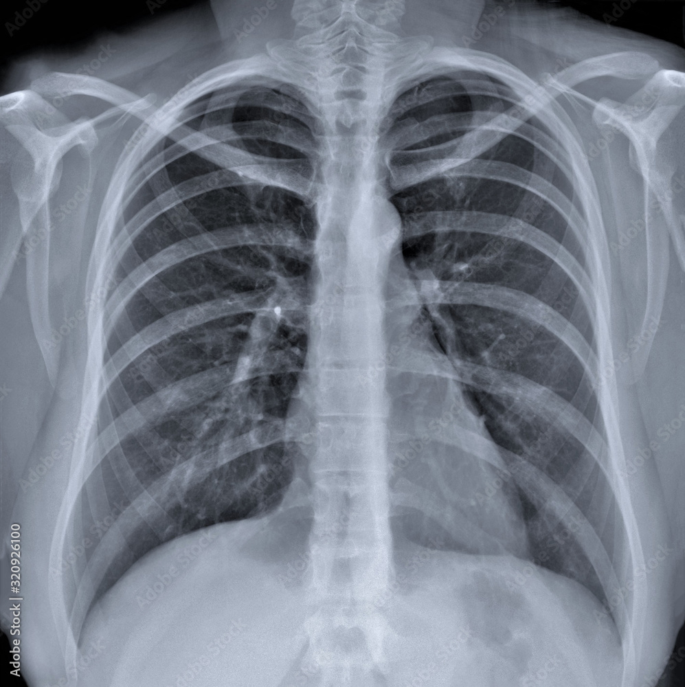 normal radiography of chest organs in direct projection, traumatology and orthopedics, injury normal radiography of chest organs in direct projection, traumatology and orthopedics, injury