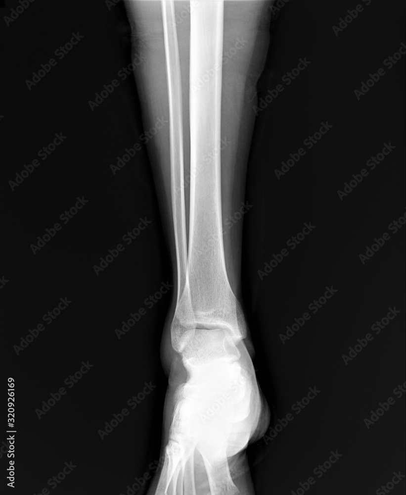 normal radiography of the ankle joint in the lateral projection normal radiography of the ankle joint in the lateral projection