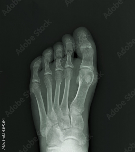 normal radiography of the foot, medical diagnostics, traumatology and orthopedics, rheumatology