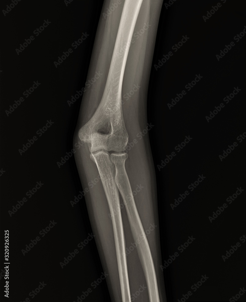 x-ray of the normal elbow joint. traumatology and orthopedics, medical diagnostics, rheumatology x-ray of the normal elbow joint. traumatology and orthopedics, medical diagnostics, rheumatology