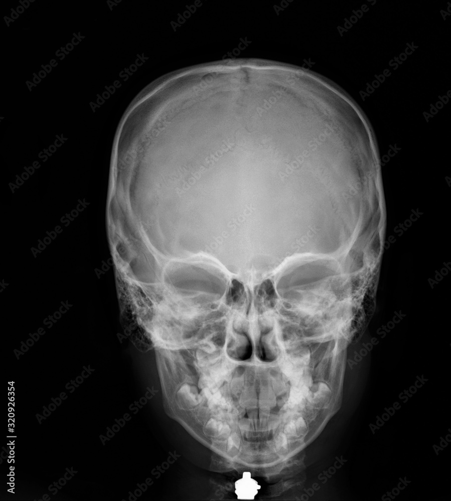 normal x-ray of the skull in direct projection, medical diagnostics, traumatology and orthopedics, neurosurgery normal x-ray of the skull in direct projection, medical diagnostics, traumatology and orthopedics, neurosurgery