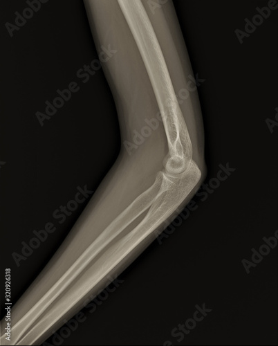 x-ray of the normal elbow joint. traumatology and orthopedics, medical diagnostics, rheumatology