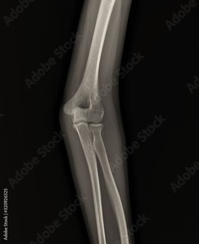 x-ray of the normal elbow joint. traumatology and orthopedics  medical diagnostics  rheumatology