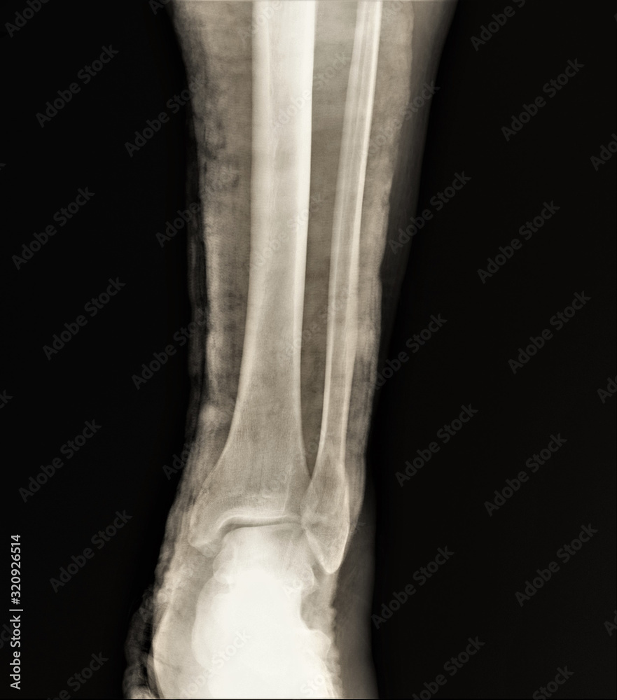fracture of the lateral ankle on x-ray fracture of the lateral ankle on x-ray