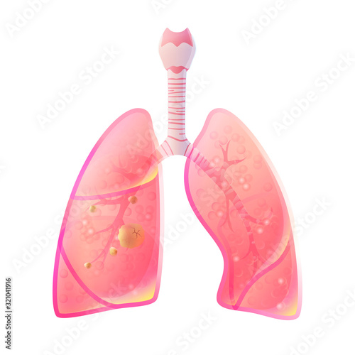 Vector illustration of lung cancer