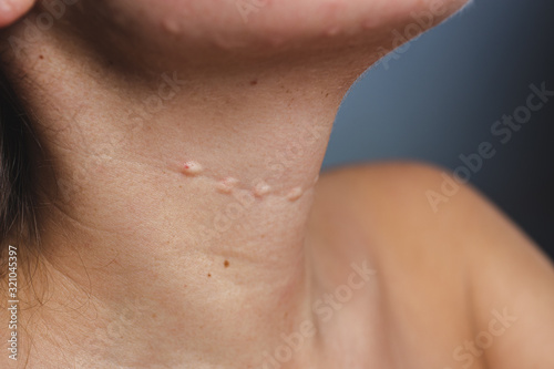 Wallpaper Mural Real skin Biorevitalization. Traces of biorevitalization injections on the neck. Biorevitalization needle marks on the neck Torontodigital.ca
