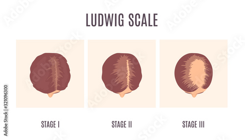 Female-pattern hair loss by Ludwig scale. 3 stages of baldness in women. Classification of alopecia shown on a head in top view. Beauty and health care concept. Medical vector illustration.
