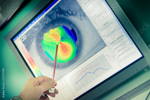 Corneal topography