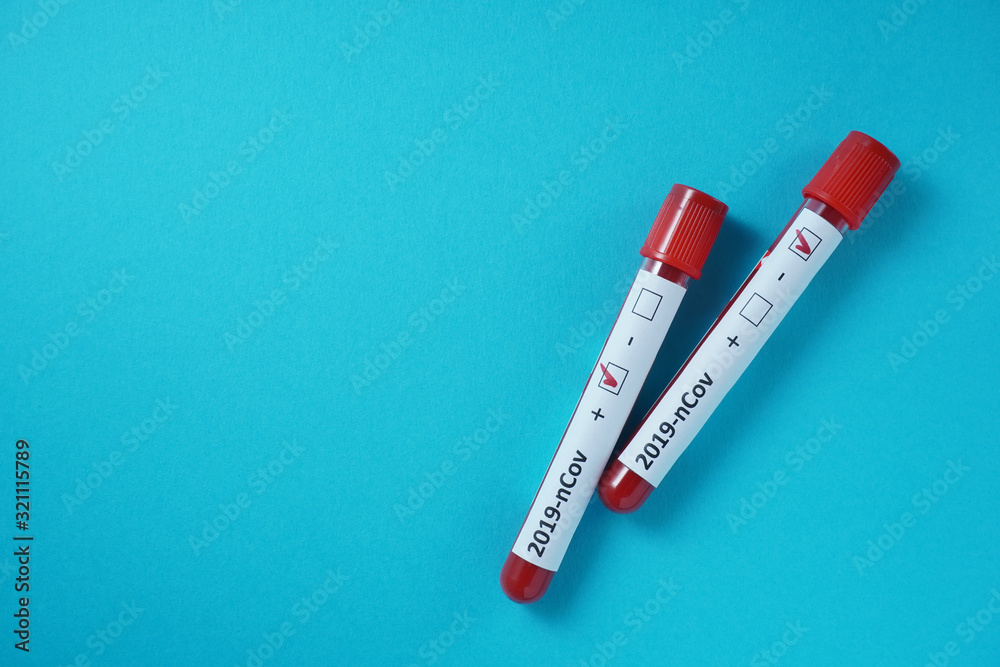 Blood test result for the new rapidly spreading Coronavirus, originating in Wuhan, China. 2019-nCoV Blood test result for the new rapidly spreading Coronavirus, originating in Wuhan, China. 2019-nCoV