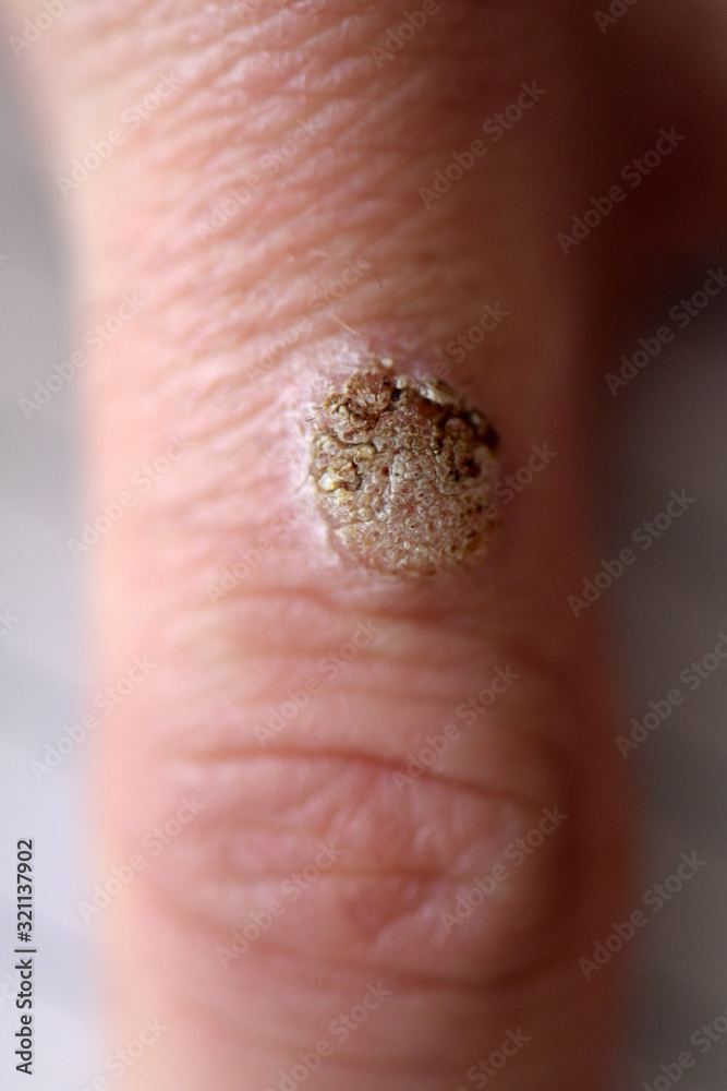 Obraz premium Wart on the hand finger.