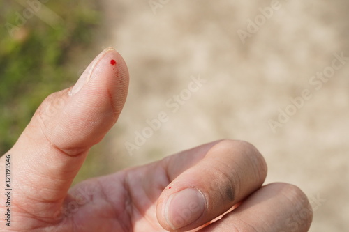 A person with a drop of blood on their thumb from a cat attack